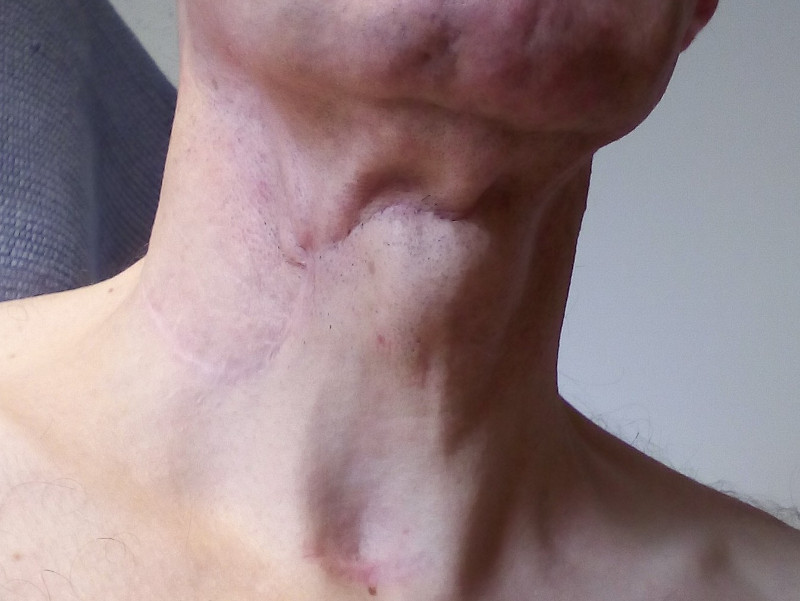 neck_scar